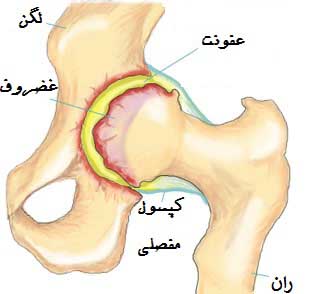 دررفتگي هاي اکتسابي مفصل ران